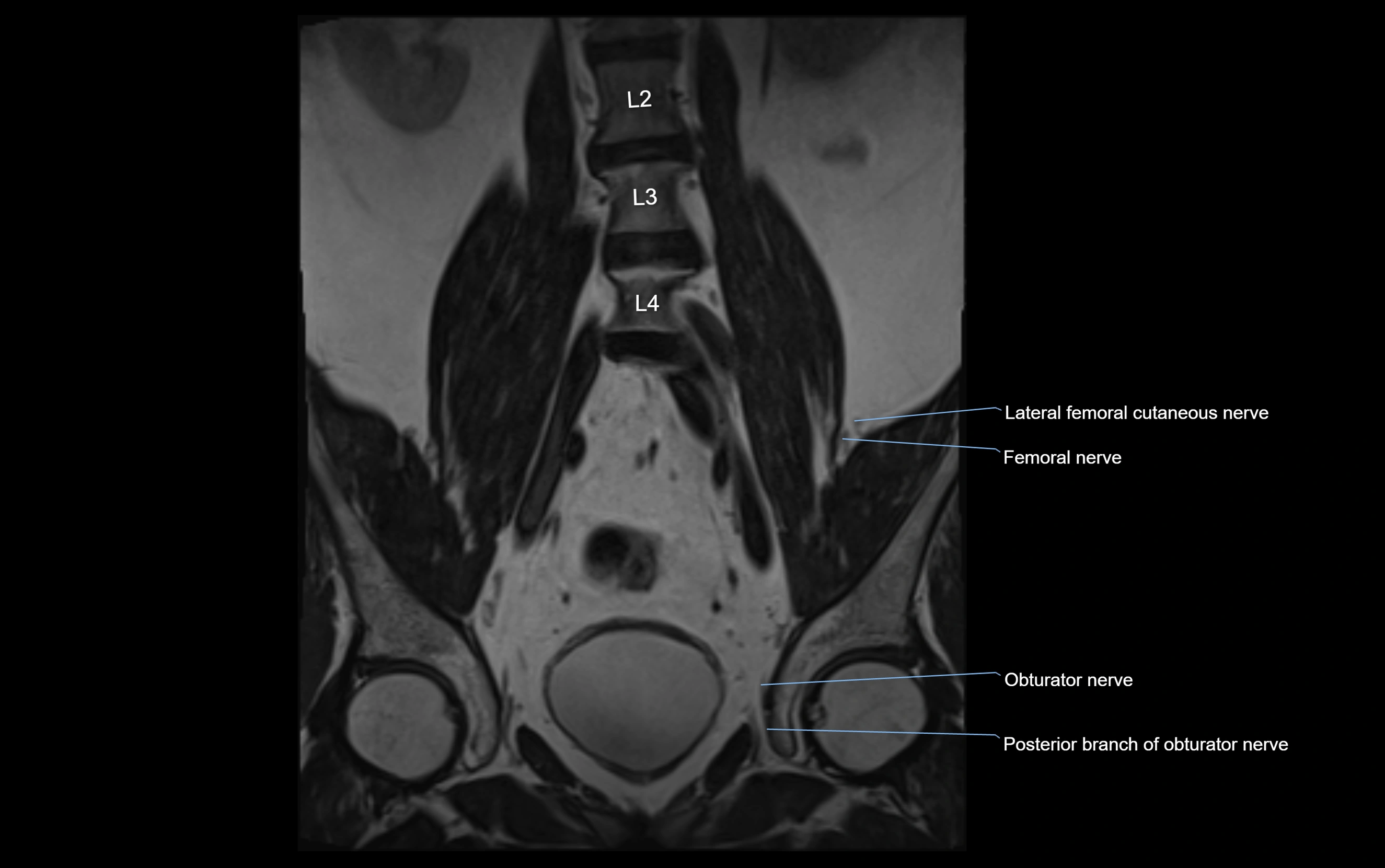 MR lumbosacral plexus cross sectional anatomy 3T  radiology  image-img-09001-00014.webp